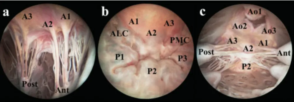 Fig. 2 The endoscopic view of the mitral valve introduced (a) a 70 degrees rigid endoscope through the aortic valve, (b) a 0 degrees endoscope through the left atrium, and (c) a 0 degrees endoscope through the apex of the heart with saline ﬁlling of the le