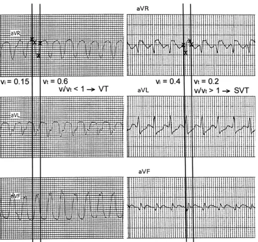 Figure 3. The use of v i /v t criterion in the fourth step of the new aVR algorithm. In both panels the crossing points of the vertical lines with the QRS contour in lead aVR show the onset and end of the QRS complex in lead aVR
