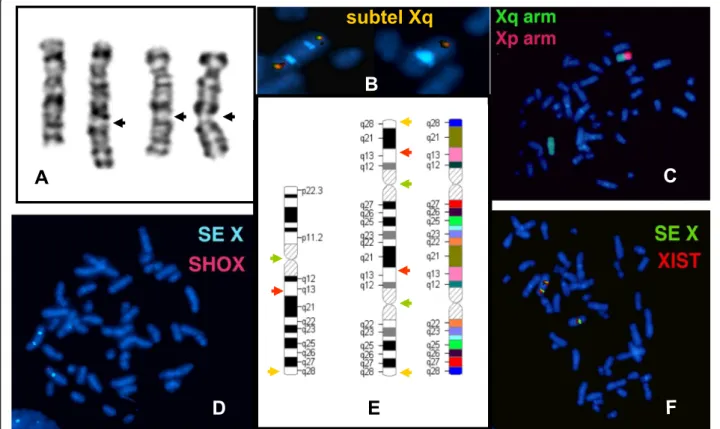 Fig. 1 The G-banding and FISH analysis of the rearranged and normal X chromosome. The G-band pattern of the normal and rearranged X chromosome showing multiple appearance from different metaphases of the rearranged X chromosome depending on the state of co