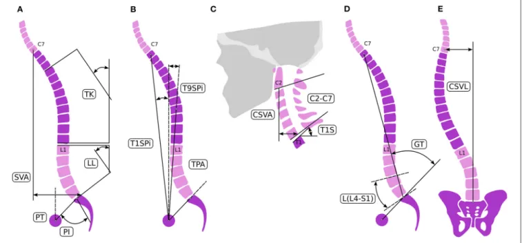 FIGURE 1 | Spinal alignment evaluation. Sagittal spino-pelvic parameters (A–C) for the assessment of the alignment [A–C adopted from Lafage et al