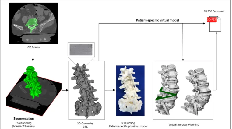 FIGURE 2 | Definition of virtual 3D geometry from CT scan. During the segmentation process the bone volume is first separated from the surrounding soft tissue by thresholding of the greyscale levels of the CT images