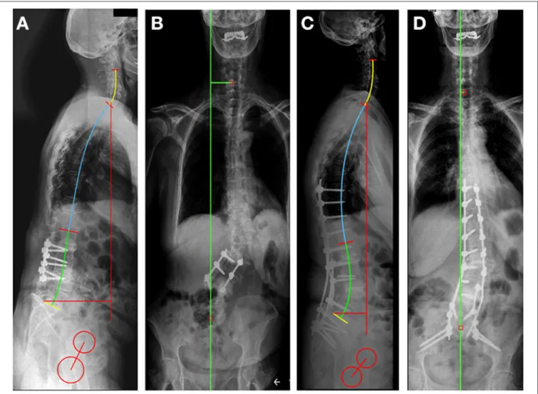 FIGURE 3 | Preoperative (A,B) and postoperative (C,D) standing X-rays for sagittal (A,C) and coronal (B,D) spinal alignment evaluation, using the Surgimap software sagittal alignment tools