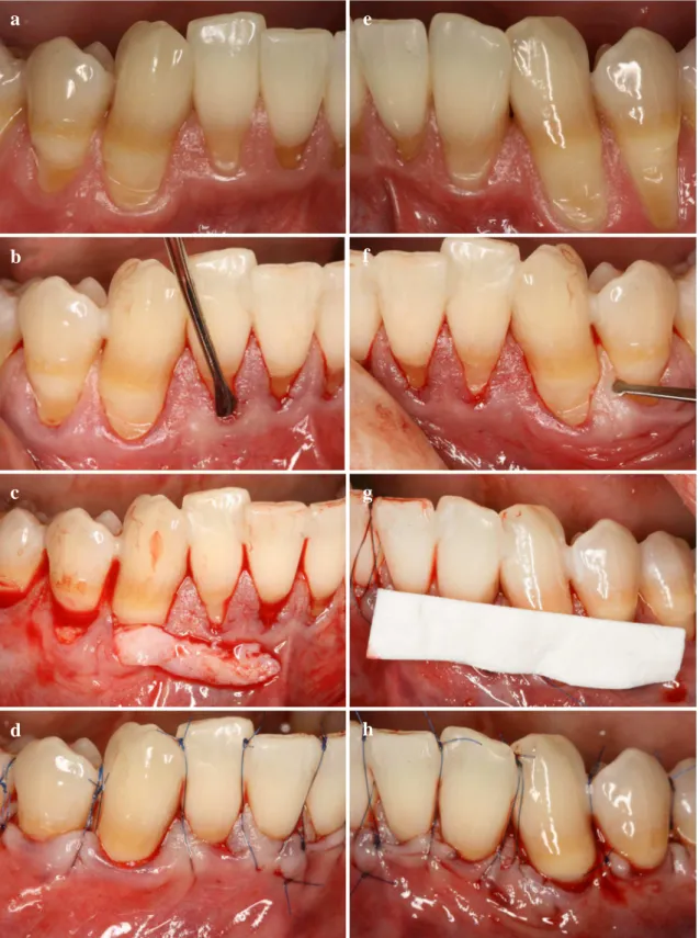 Fig. 4 Split Mouth Modified Coronally Advanced Tunnel Technique (MCAT) in combination with either  subgingival connective tissue graft (SCTG) or Mucograft ®  (CM) (a) Control side prior treatment (b) Control  side tunnel preparation (c) Control side SCTG i