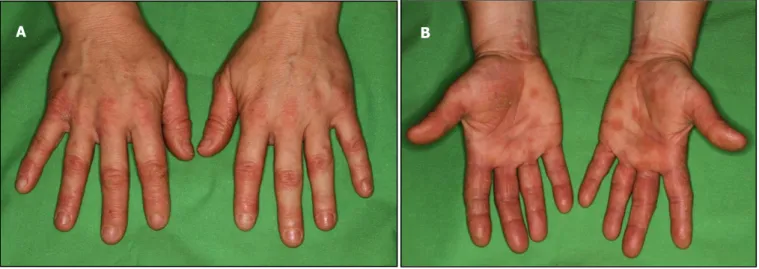 Figure 1. a-b Contact dermatitis on the hand provoked by nursing the lavender plant of a 55 year old female  patient (patient no
