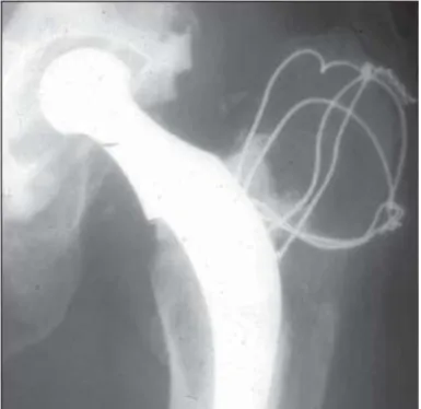 1. ábra. Első generációs Charnley-féle alacsony súrlódású arthroplasztika 26 éves  utánkövetésének röntgen felvétele (14)