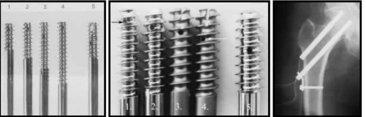 28. ábra:  18,  24,  34,  44  mm  menethosszúságú  Manninger  csavar,  a  combfej  drainagéjét  lehetővé  tevő  lyukak  a  csavarban,  a  combfej  dekompressziója  a  csavar furatába helyezett drainnel  