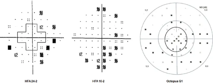 Fig 1. Pattern deviation plots of the Humphrey Field Analyzer (HFA) 24–2 test and the HFA 10–2 test, and the corrected probability plot of the Octopus G1 program of the same early glaucoma eye from the study