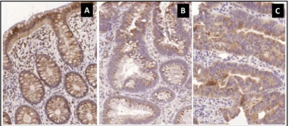 Fig. 4. Septin-9 immunohistochemistry in tissue samples. Decreased epithelial expression of Septin-9 protein (brown cytoplasmic immunoreaction) in adenoma (B) and CRC (C) compared to the normal (A) samples (Digital microscope pictures, 20x relative magnifi