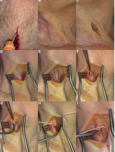 Figure 1: Step by step protocol for Thiel's solution and latex milk injection. (A) Catheter placement in the superior sagittal sinus for injection of Thiel's solution
