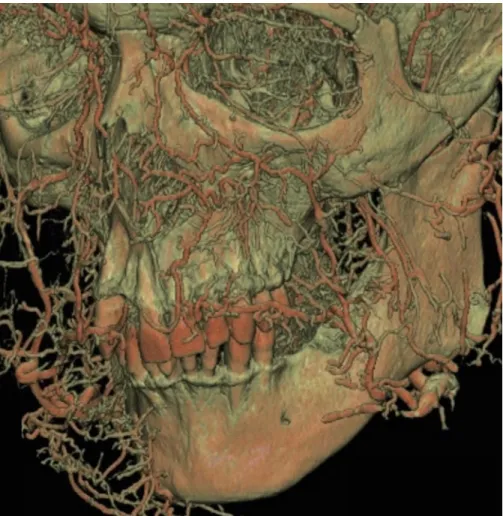 Figure 5: CT images of the various arterial pathways injected with the red colored latex milk in the maxillofacial region