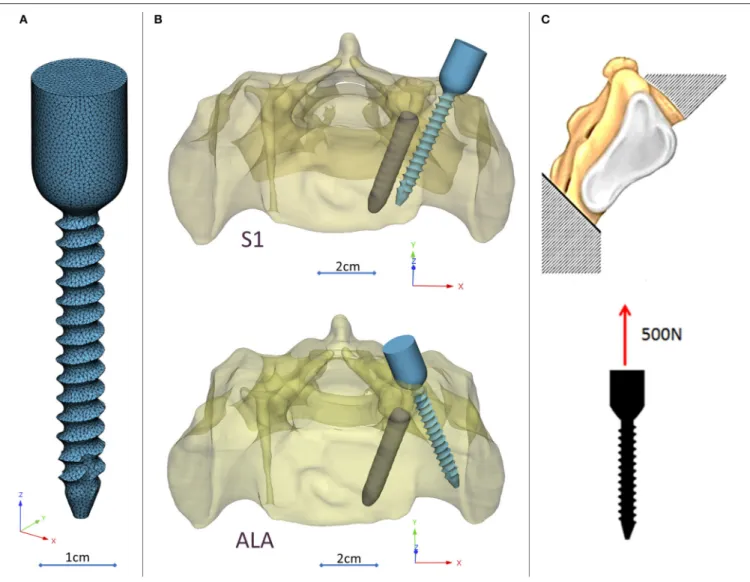 FIGURE 3 | Virtual pedicle screw insertion into the patient-specific sacrum model. (A) Modified (monoaxial) virtual model of the pedicle screw