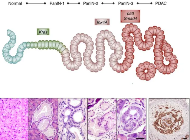 Figure 1. Multistep pancreatic carcinogenesis.  (Upper) Scheme  of step-wise genetic  alterations  followed  by  histological  transformation