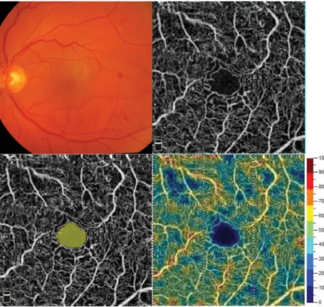 1. ábra Diabeteses beteg színes szemfenéki felvétele (bal felső kép), valamint OCT-angiográfiás képei az érhálózat áttekintő ábrázolásával (jobb felső kép),  a foveolaris avascularis zóna kijelölésével (bal alsó kép) és a retinalis érhálózat sűrűségének sz