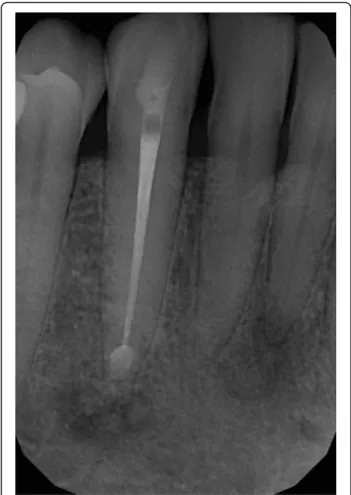 Figure 4 shows the postoperative condition (Fig. 4). At the 6-months periapical follow-up, the bone healing is being processed (Fig