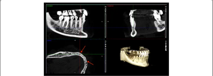 Fig. 7 Histological image of the COD lesion of the first patient.