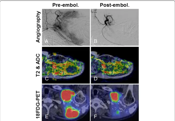 Figure 1 Post-embolization tumor response in the shoulder plasmacytoma could be best demonstrated with functional imaging studies