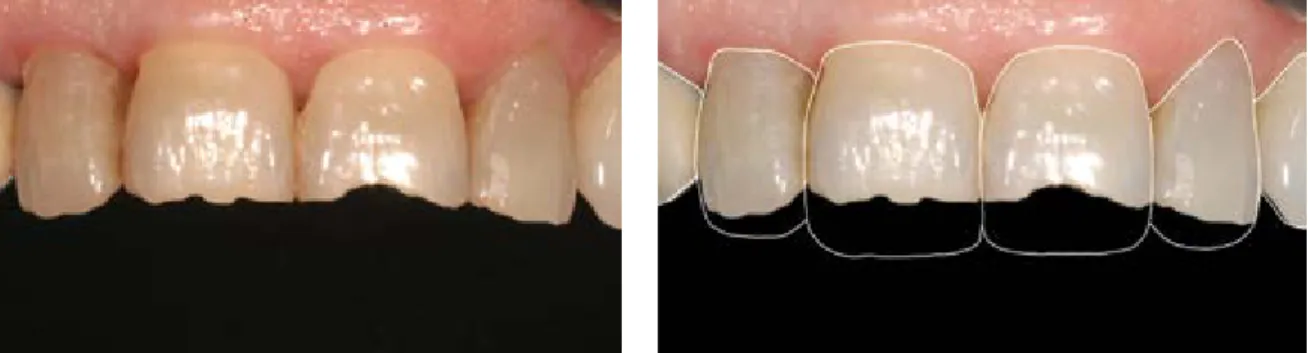 Figure 4. Diagnostic wax-up Figure 3. In young patients, tooth width is 