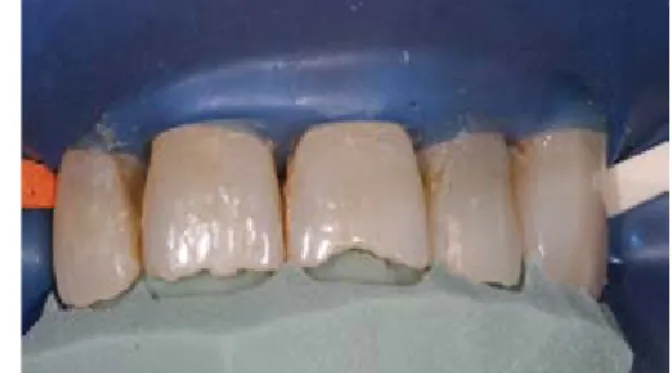 Figure 5. After creating the mock-up, it is possible  to do corrections intraorally upon the patient’s  request