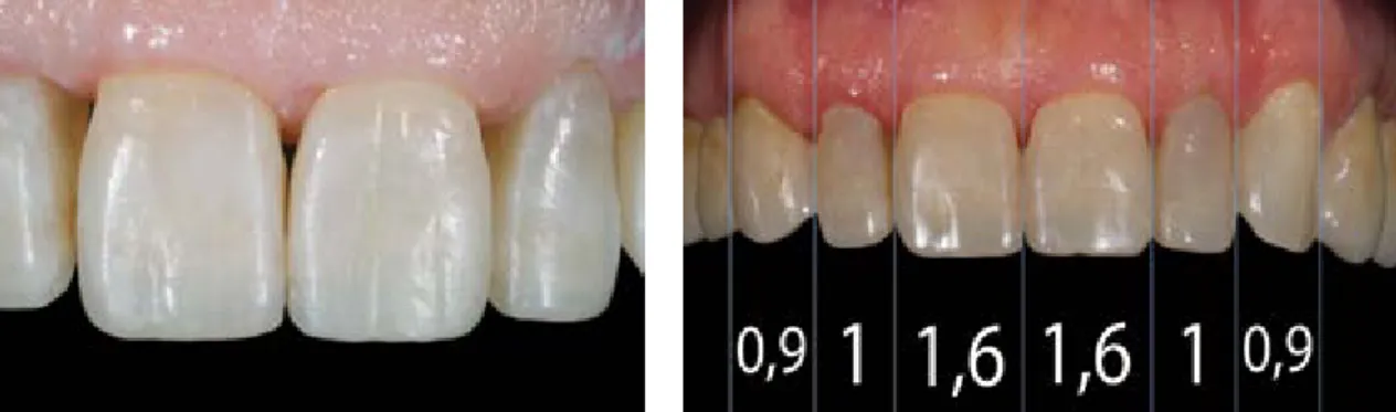 Figure 12. The relative widths of the teeth can be  evaluated. It is visible that the ratio of the large and  small incisors complies with the “golden standard” 