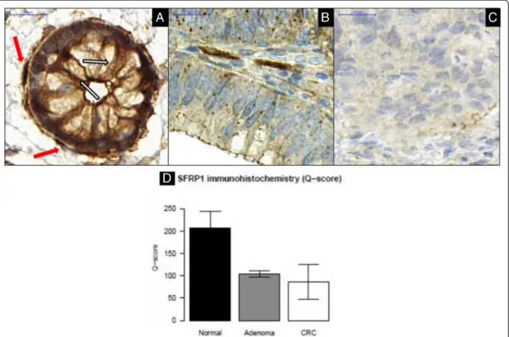 Fig. 5 Continuously decreasing SFRP1 protein expression could be observed along colorectal adenoma-carcinoma development in epithelial/CRC compartment of NAT (a), AD (b), and CRC (c) samples