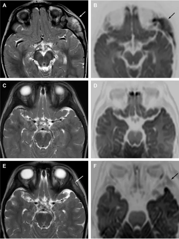 Figure 1 The role of head MrI in the evaluation of therapy response.