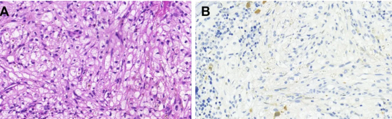 Figure 3 Massive bone marrow infiltration with ECD (original magnification).