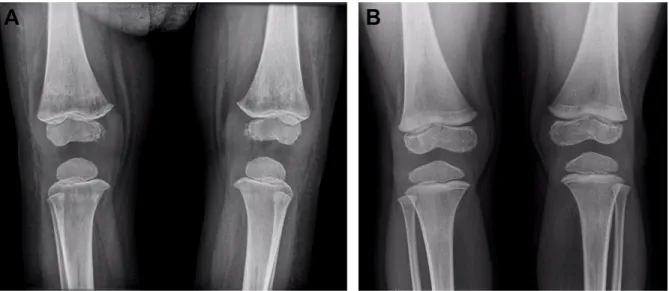 Figure 5 Coronal T2W image of the spine shows very low signal intensity of the  bone marrow that is specific for ECD.