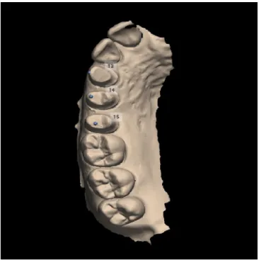 FIGURE 1 Scan of prepared dies in the DentalDesigner CAD program