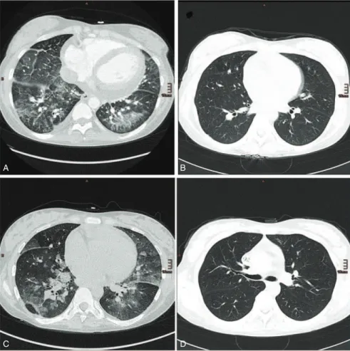FIGURE 1. (A) Diffuse pulmonary hemorrhage in both lower lobes, which resolved after another initiation of (B) IAS