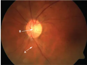 3. ábra Uveitis anterior Behcet-kór relapsusában: a cornea körül ciliaris  belövelltség, hátlapján friss precipitátumok