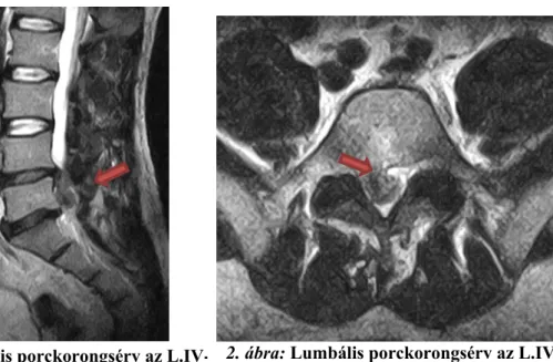 1. ábra: Lumbális porckorongsérv az L.IV-V  szegmentumban (MR, T2, szagittális)
