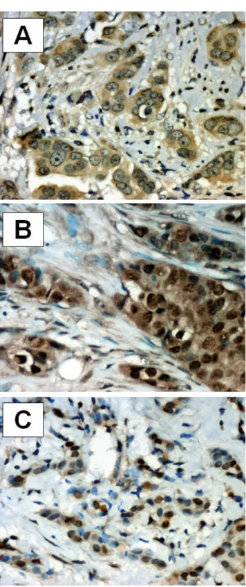 Fig. 1. Immunohistochemical localization of S100P expression in breast cancer: A. Cytoplasmic reaction; brown reaction product; S100Pn IRS=0, S100Pc IRS=8 (hematoxylin)