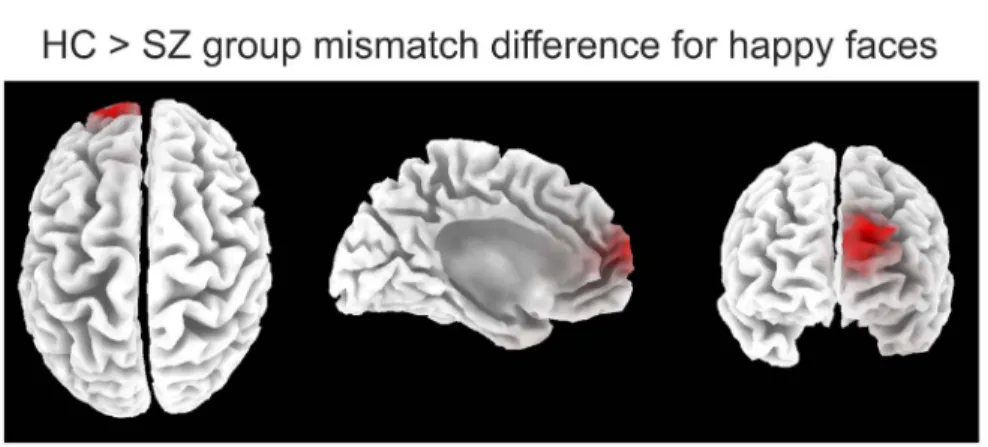 Figure 5. Results of the source localization for the happy condition. Red color indicates significant group differences in mismatch generation to the happy condition in the 250–360 ms time window