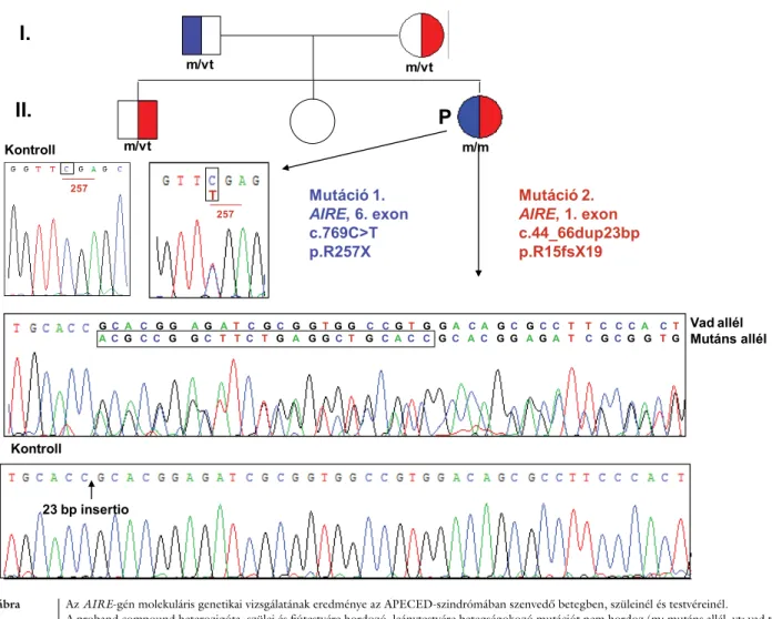 2. ábra Az AIRE-gén molekuláris genetikai vizsgálatának eredménye az APECED-szindrómában szenvedő betegben, szüleinél és testvéreinél