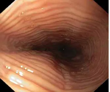 1. ábra Eosinophil oesophagitis felső panendoszkópos képe: gyűrűkép- gyűrűkép-ződés