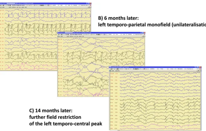 Fig. 6. Regression of spiking during remission of ESES. A: Left dominant bilateral temporo-central monoﬁeld, B: 6 mo later left temporo-parietal monoﬁeld (unilateralisation), C: