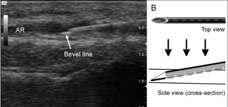 Figure 1. Bevel line and explanation. AR= Arteria radialis. 