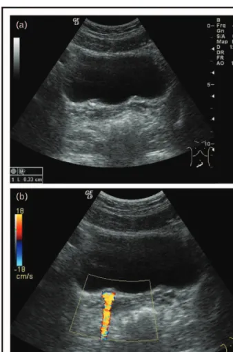 FIGURE 5. A nonobstructive small stone is shown at the ureterovesical junction (a). A stone-triggered artifact called twinkling artifact is seen (in the same patient) with color Doppler imaging (b).