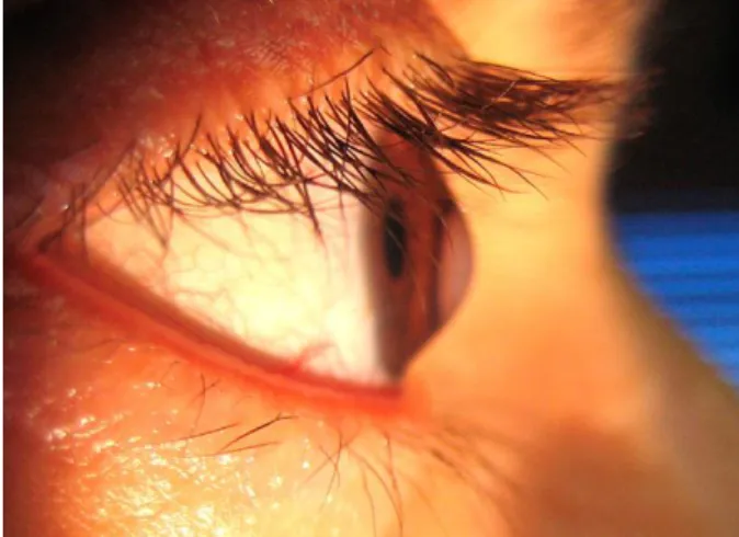 Figure 2.: Keratoconic eye.  