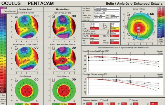 Figure 8.: Keratoconus screening with BAD III. method.  This case is a  moderately advance  keratoconus  where  all  the  analyzed  parameters  measured  in  the  BAD  III