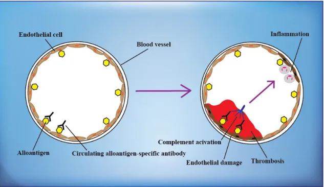 Figure  5.  Hyperacute  allograft  rejection.  Preformed  donor-specific  antibodies  react  with alloantigens, such as blood group or HLA on the vascular endothelium of the graft,  and activate complement, cause inflammation and trigger rapid intravascula