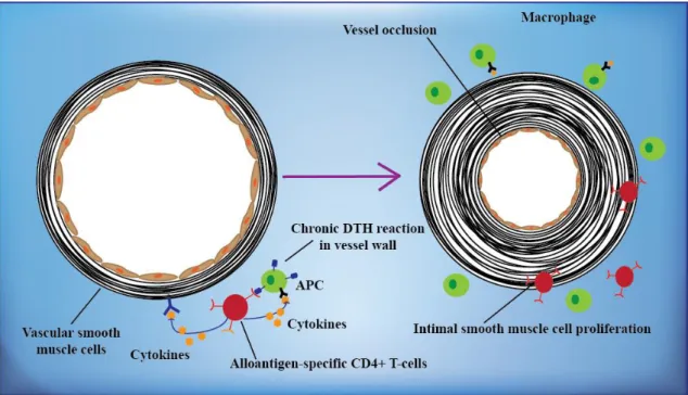 Figure  7.  Chronic allograft rejection. T-lymphocytes reactive with graft alloantigens  may produce cytokines that induce proliferation of endothelial cells and intimal smooth  muscle cells, resulting in arteriosclerosis of the graft