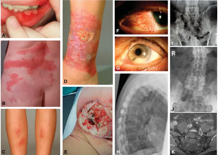 FIGURE 1. A, Oral aphthous ulcers, (B) Sweet ’ s syndrome, (C) erythema nodosum, (D) pyoderma gangrenosum, (E) peristomal pyoderma gan- gan-grenosum, (F) episcleritis, (G) uveitis with hypopyon and dilated iris vessels, (H) conventional x-ray of the latera