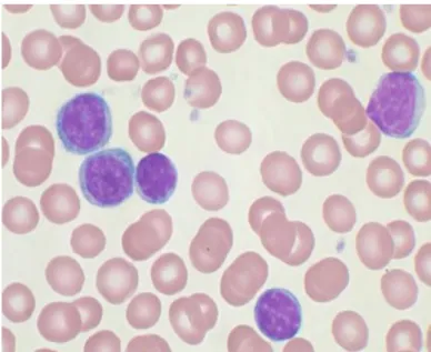 1. ábra. CLL, perifériás vér kenet (MGG, 600x). 