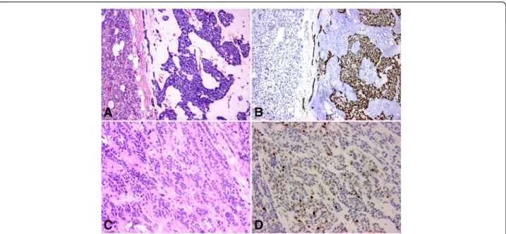 Fig. 3 H &amp; E (a) and EZH2 staining (b) of a poorly differentiated carcinoma ex pleiomorphic adenoma (40x); the tumor is strongly positive, the surrounding normal salivary gland remains negative; H &amp; E (c) and EZH2 staining (d) of a polymorphous low