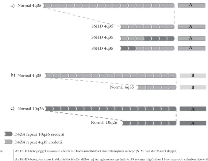 1. ábra Az FSHD-betegséggel asszociáló allélok és D4Z4-ismétlődések kontrakciójának szerepe (S