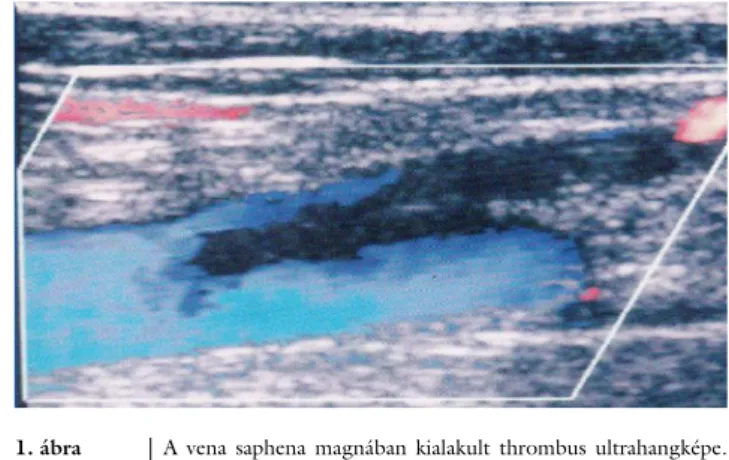 1. ábra A vena saphena magnában kialakult thrombus ultrahangképe. 