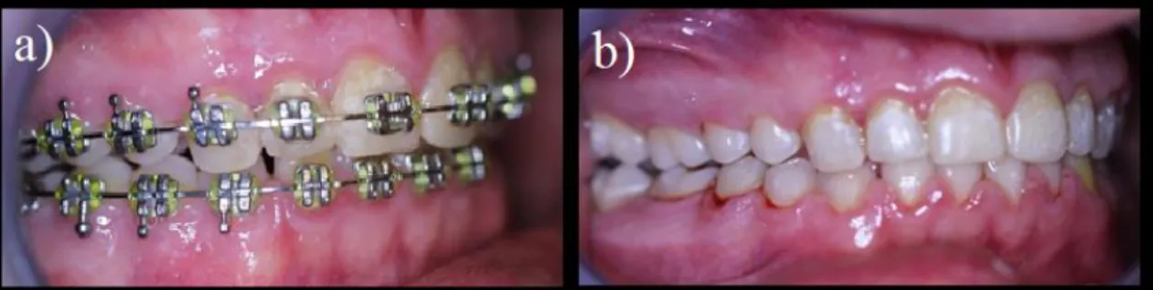 4. ábra: a) Fokozott plakk akkumuláció rögzített fogszabályozó készülék viselése alatt,  b)  White  spot  léziók  és  gingivitis  közvetlenül  a  rögzített  készülék  eltávolítása  után: 