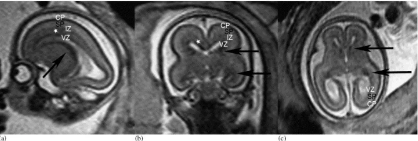Figure 3.2.2. Sagittal (a), coronal (b), and axial (c) T2-weighted sections of a 20 GW fetus