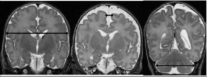 Figure   3.2.2.1.  Premature   Brain   at   Term.   .   Inder   TE  Pediatrics.  2005 Feb;115(2):286 As it is shown in the above figure, premature infants present smaller brain volumes, less cortical folding and narrower corpus callosum